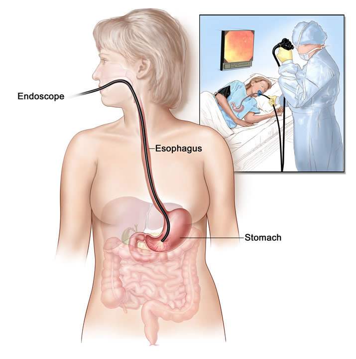 gastroscopy